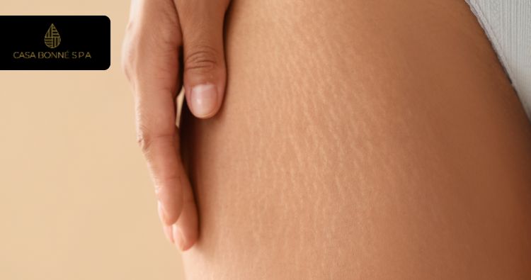 Beneficios clave del uso de Dermapen para combatir estrías | Casa Bonné Spa Guadalajara